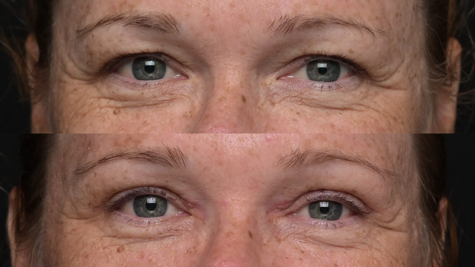 Before-and-after photograph, blepharoplasty