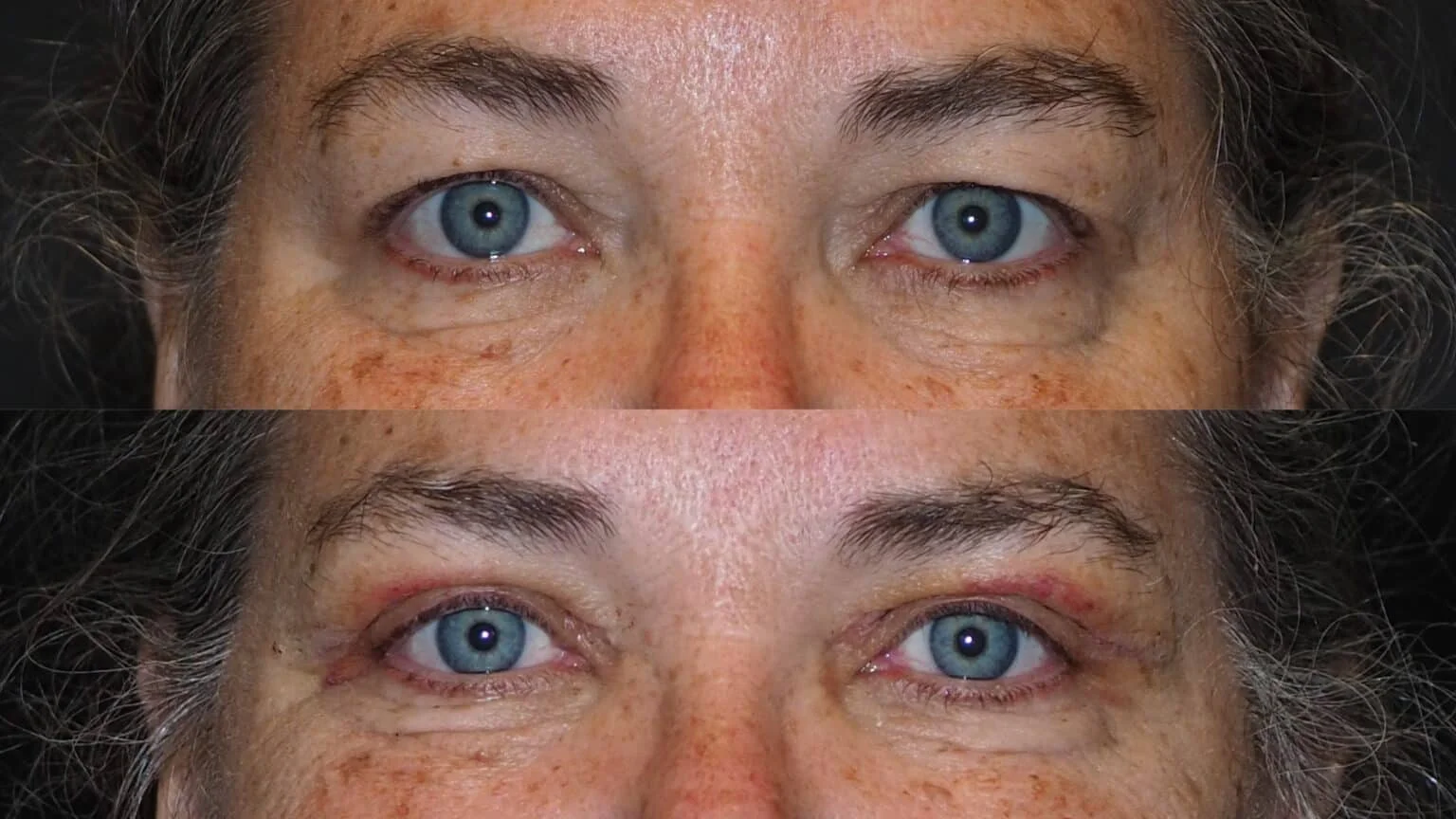 Before-and-after photograph, blepharoplasty