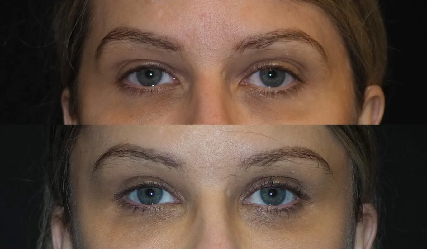 Before-and-after photograph, brow lift