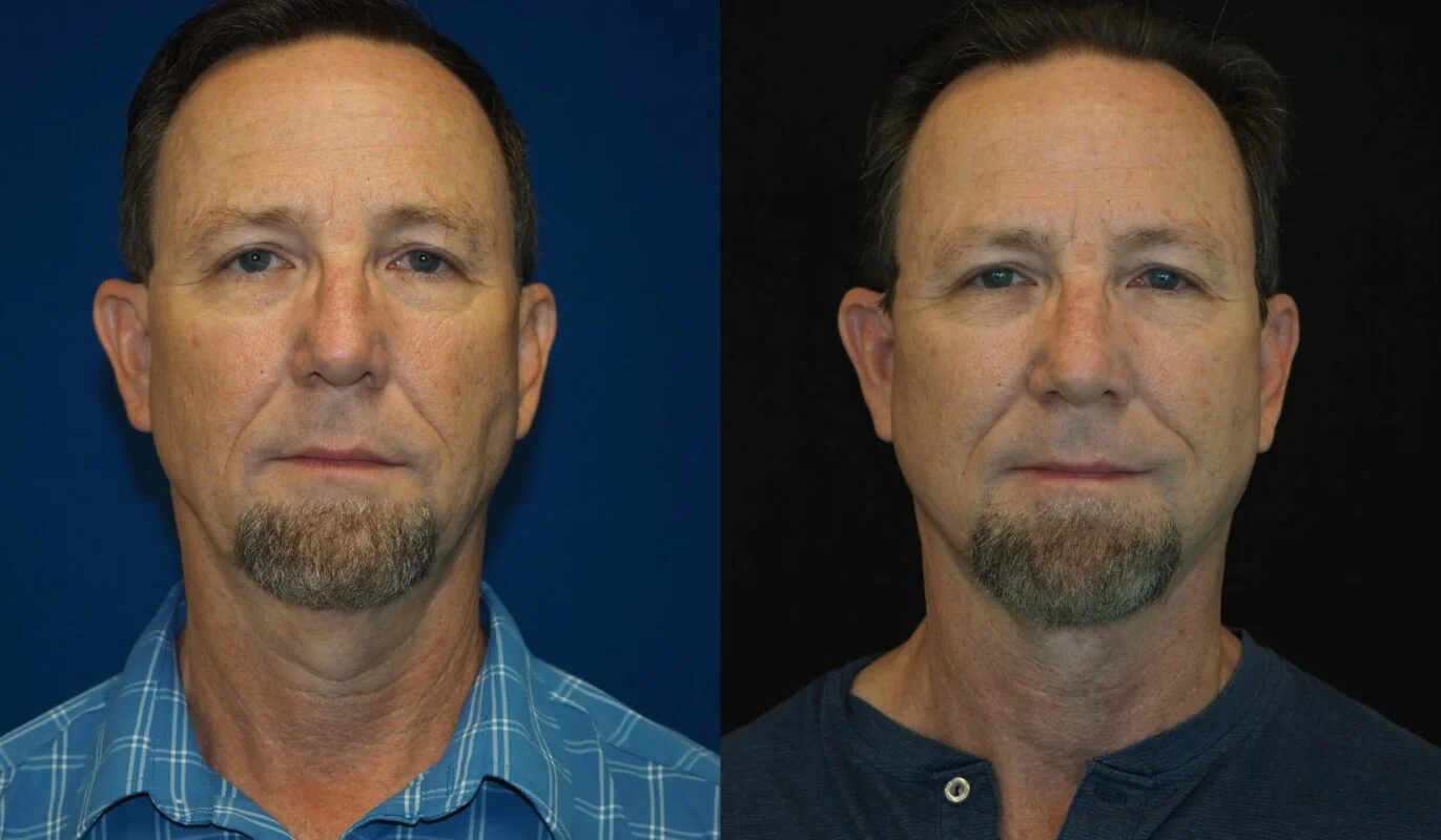 Before-and-after photograph, deep plane facelift and neck lift