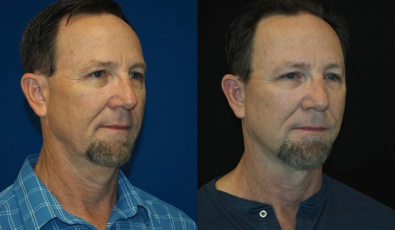 Before-and-after photograph, deep plane facelift and neck lift