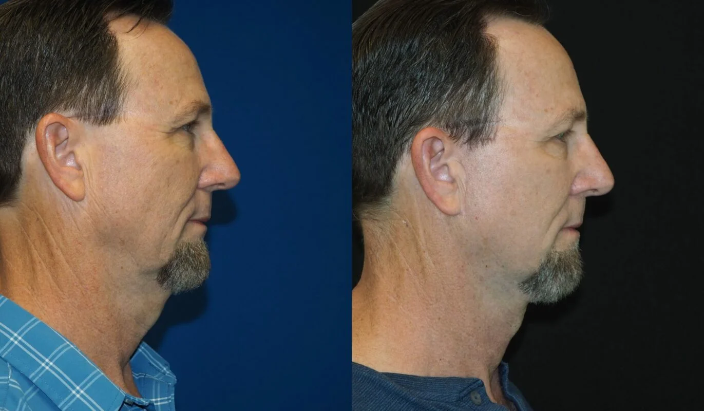 Before-and-after photograph, deep plane facelift and neck lift