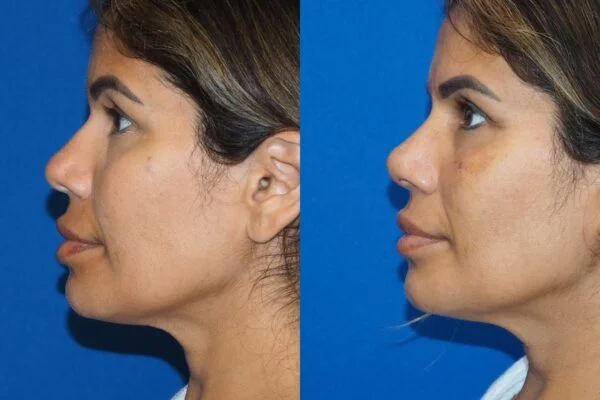 Before-and-after photograph, rhinoplasty