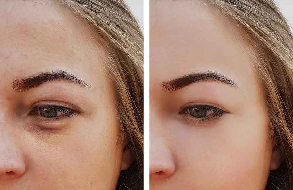 Eye rejuvenation surgery, Houston