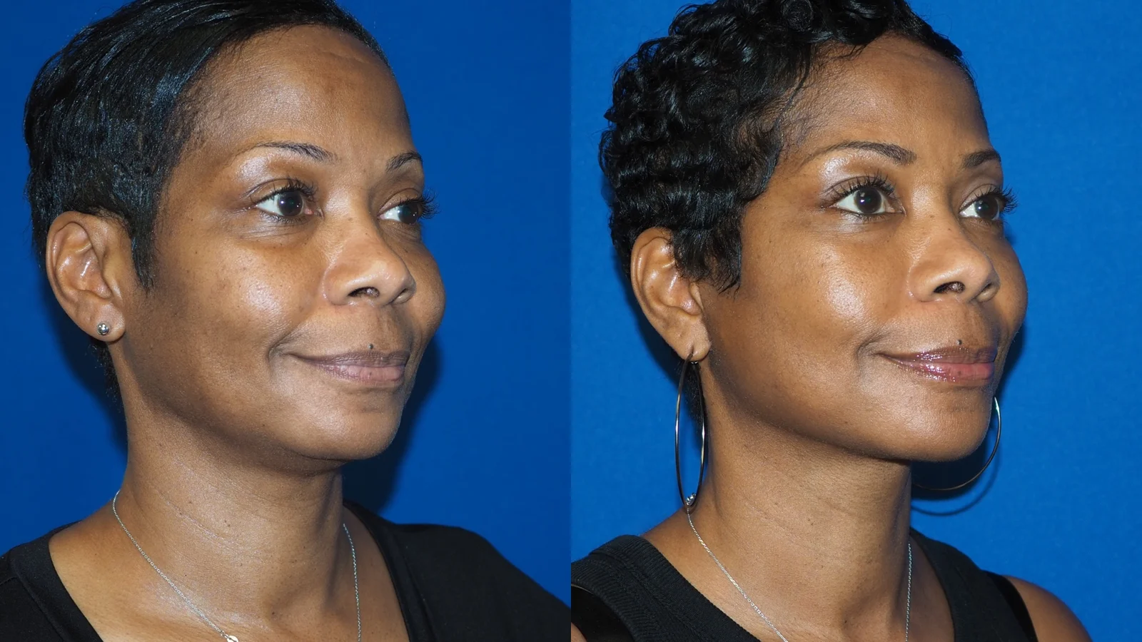 Before-and-after photograph, deep plane facelift and neck lift