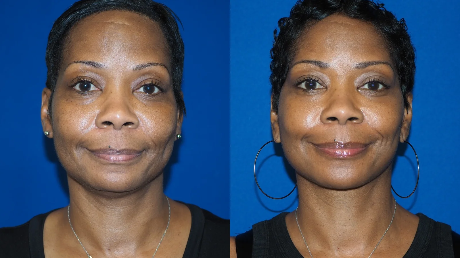 Before-and-after photograph, deep plane facelift and neck lift