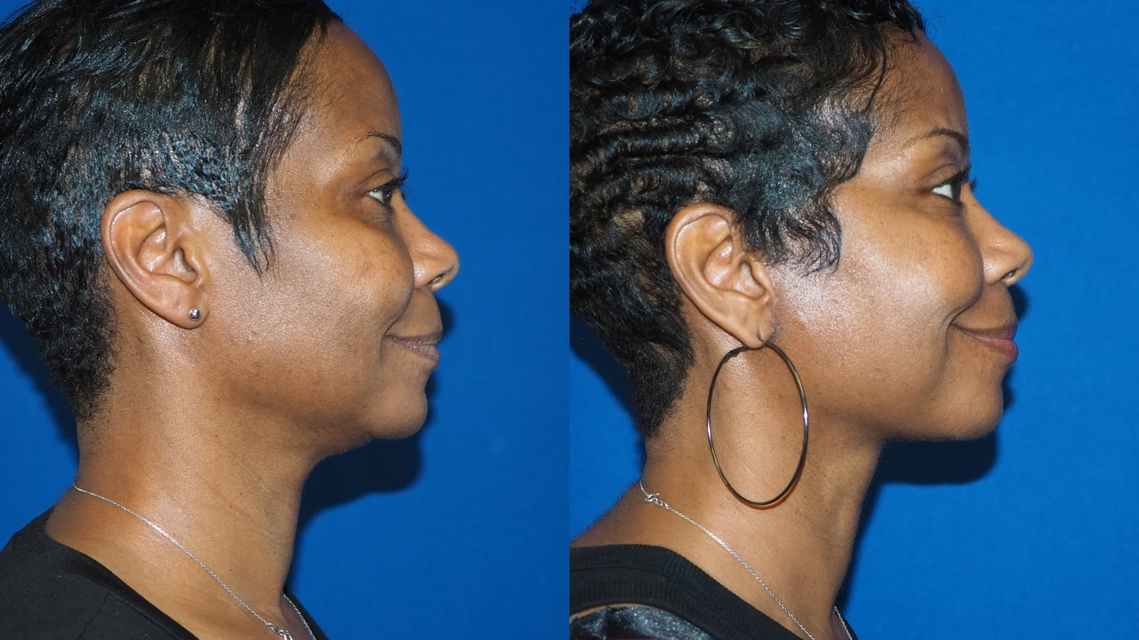 Before-and-after photograph, deep plane facelift and neck lift