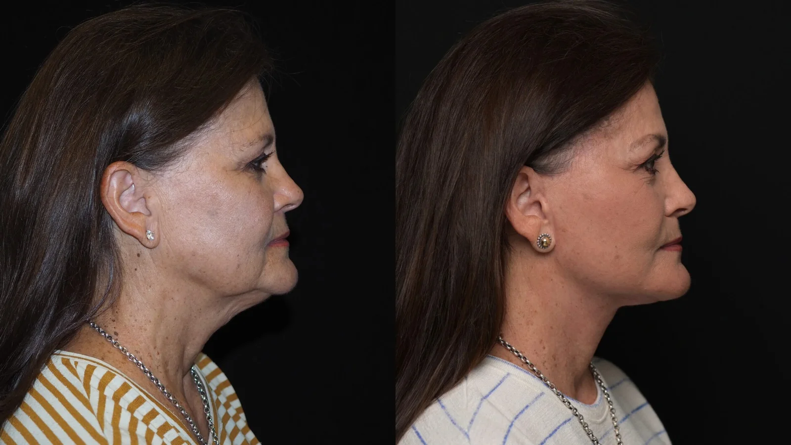 Before-and-after photograph, deep plane facelift and neck lift