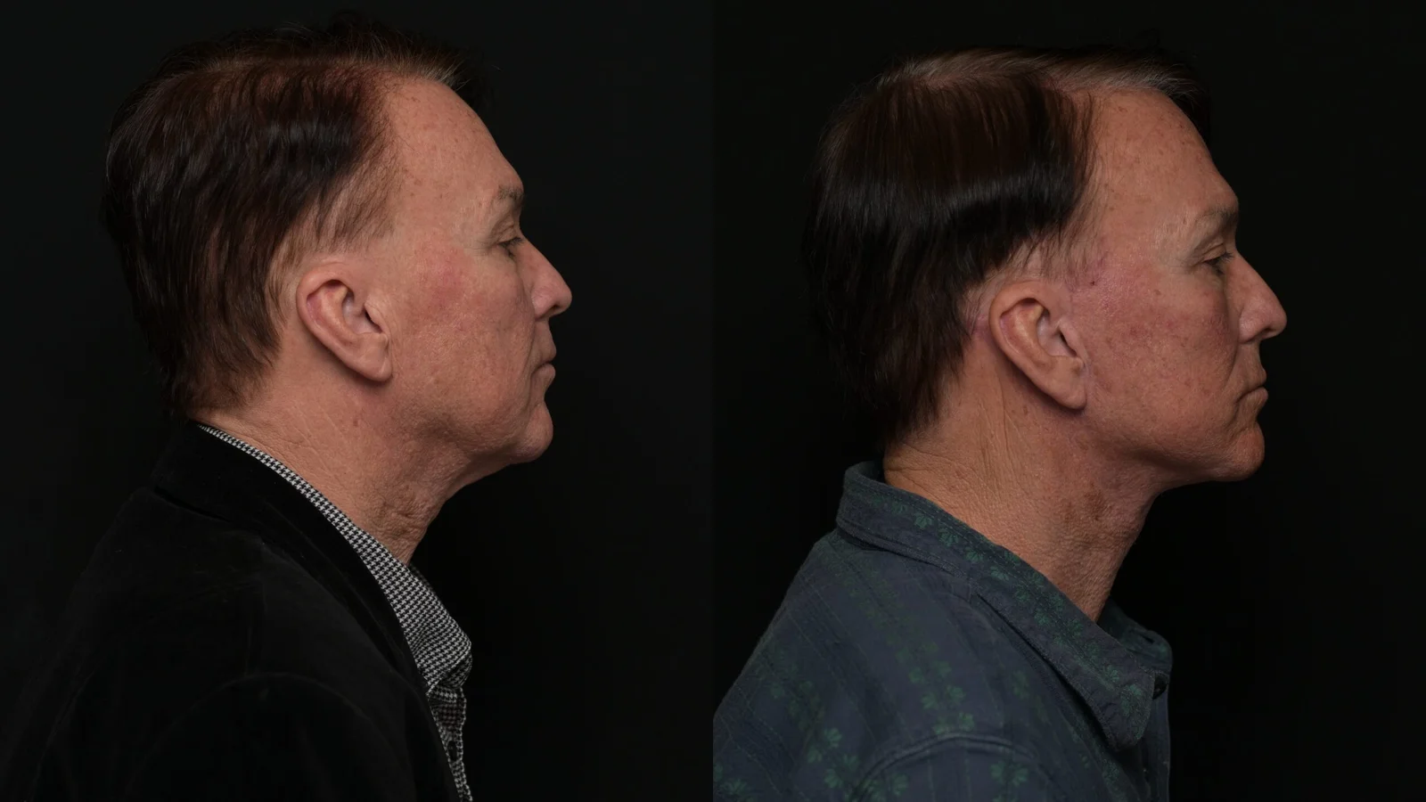 Before-and-after photograph, deep plane facelift and neck lift