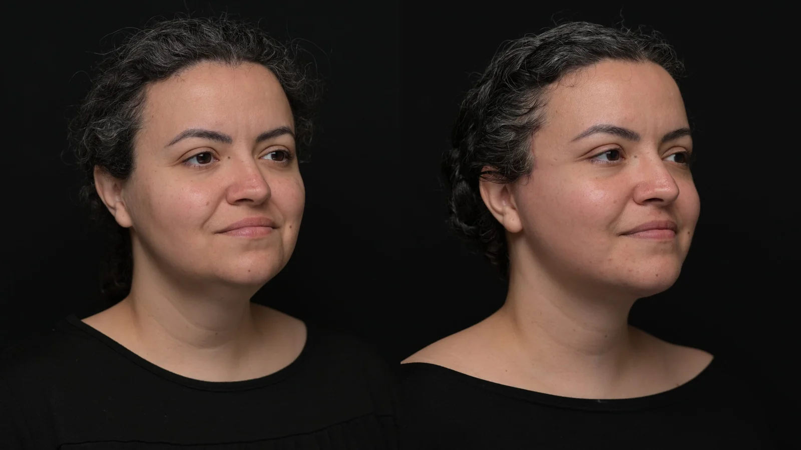 Before-and-after photograph, deep plane facelift and neck lift