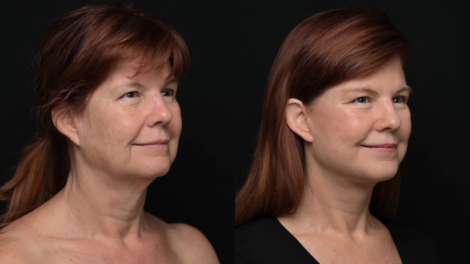 Before-and-after photograph, deep plane facelift and neck lift