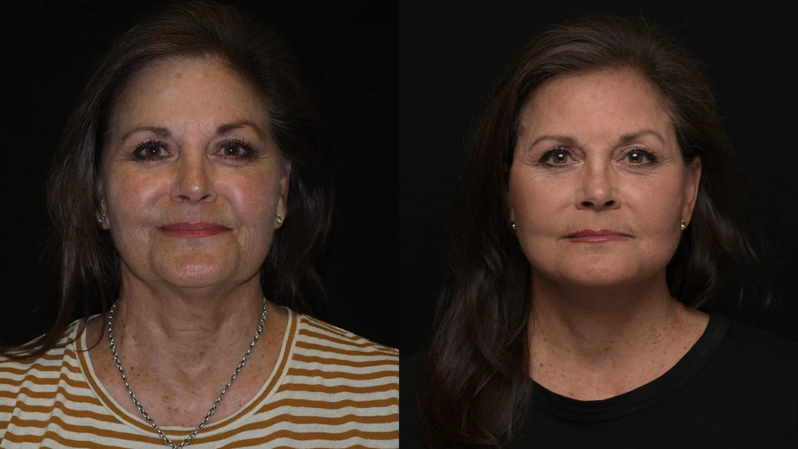 Before-and-after photograph, deep plane facelift and neck lift