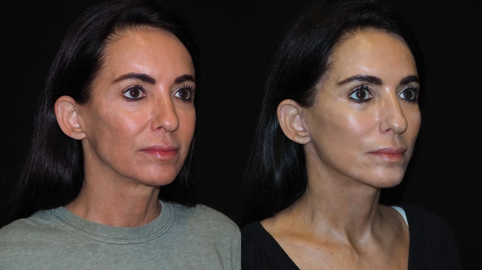Before-and-after photograph, deep plane facelift and neck lift