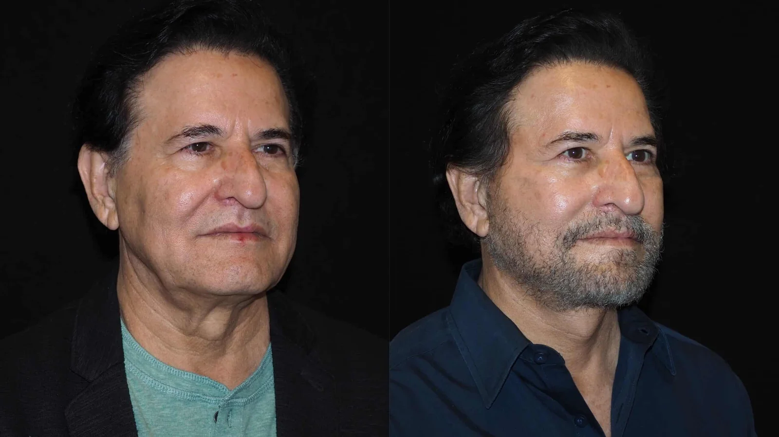 Before-and-after photograph, deep plane facelift and neck lift