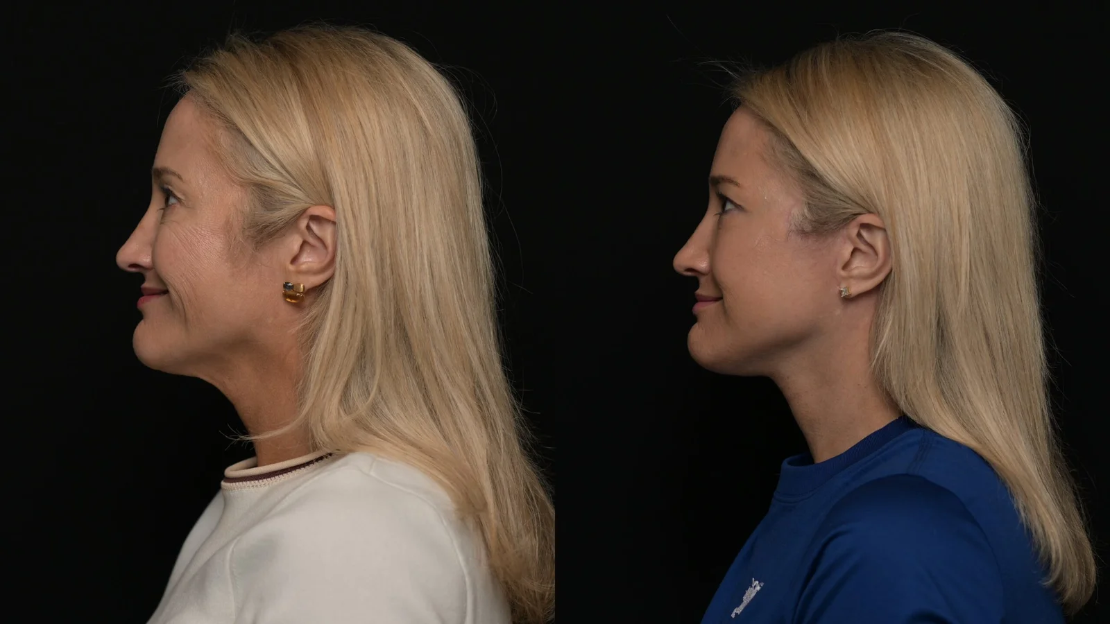 Before-and-after photograph, deep plane facelift and neck lift