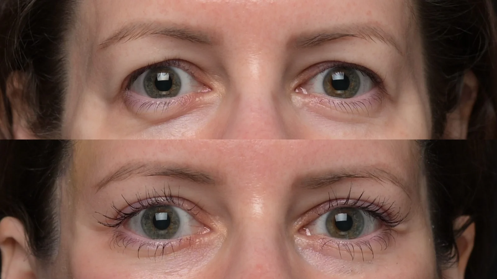 Before-and-after photograph, blepharoplasty