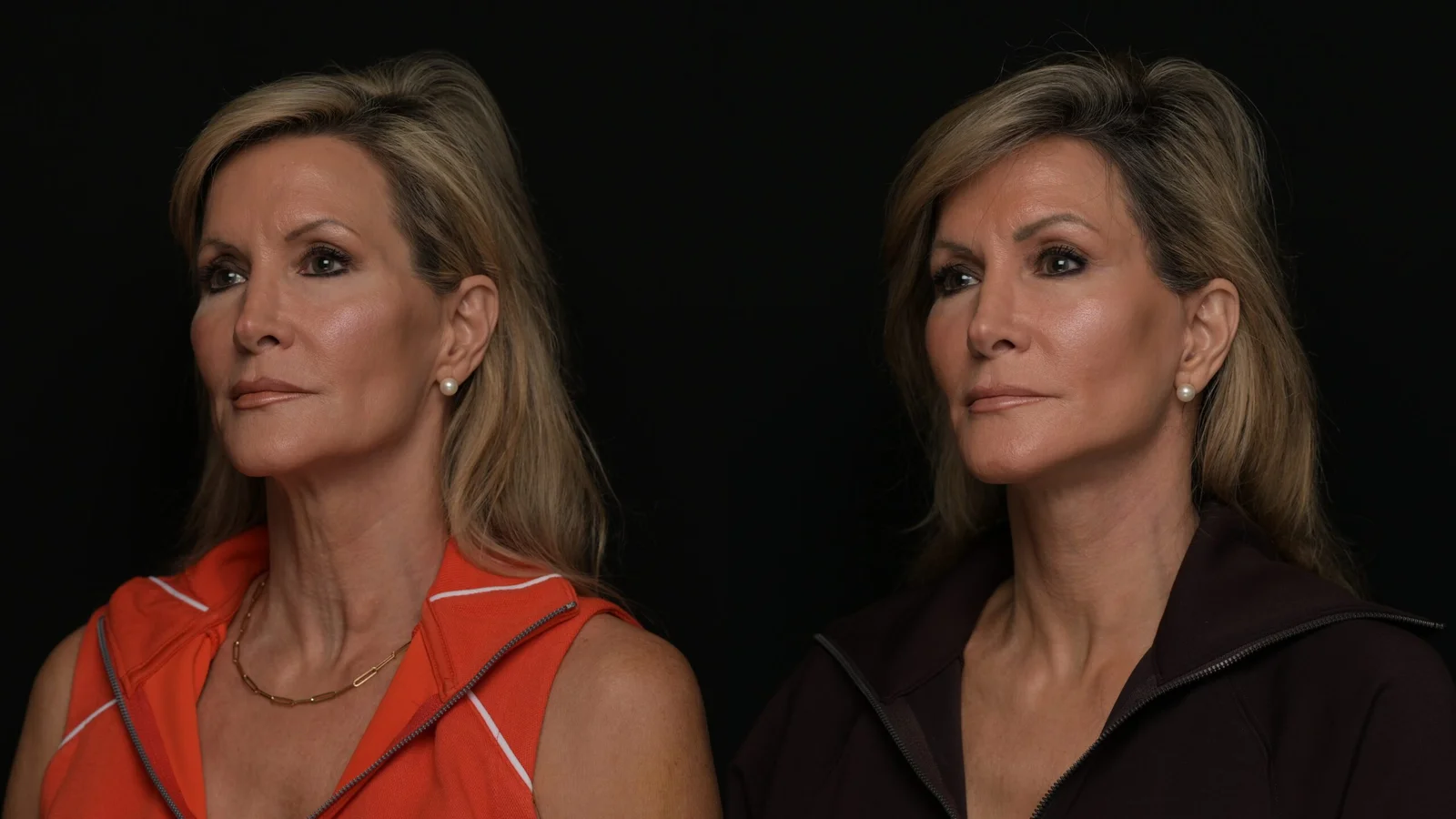 Before-and-after photograph, deep plane facelift and neck lift