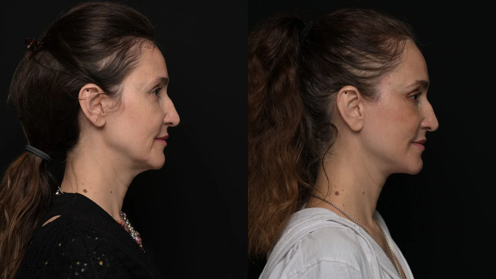 Before-and-after photograph, deep plane facelift and neck lift