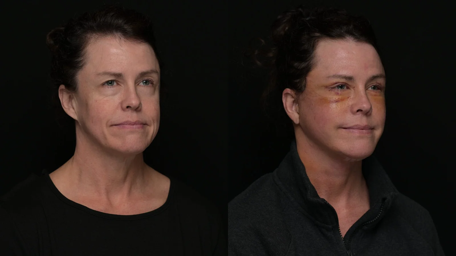 Before-and-after photograph, deep plane facelift and neck lift