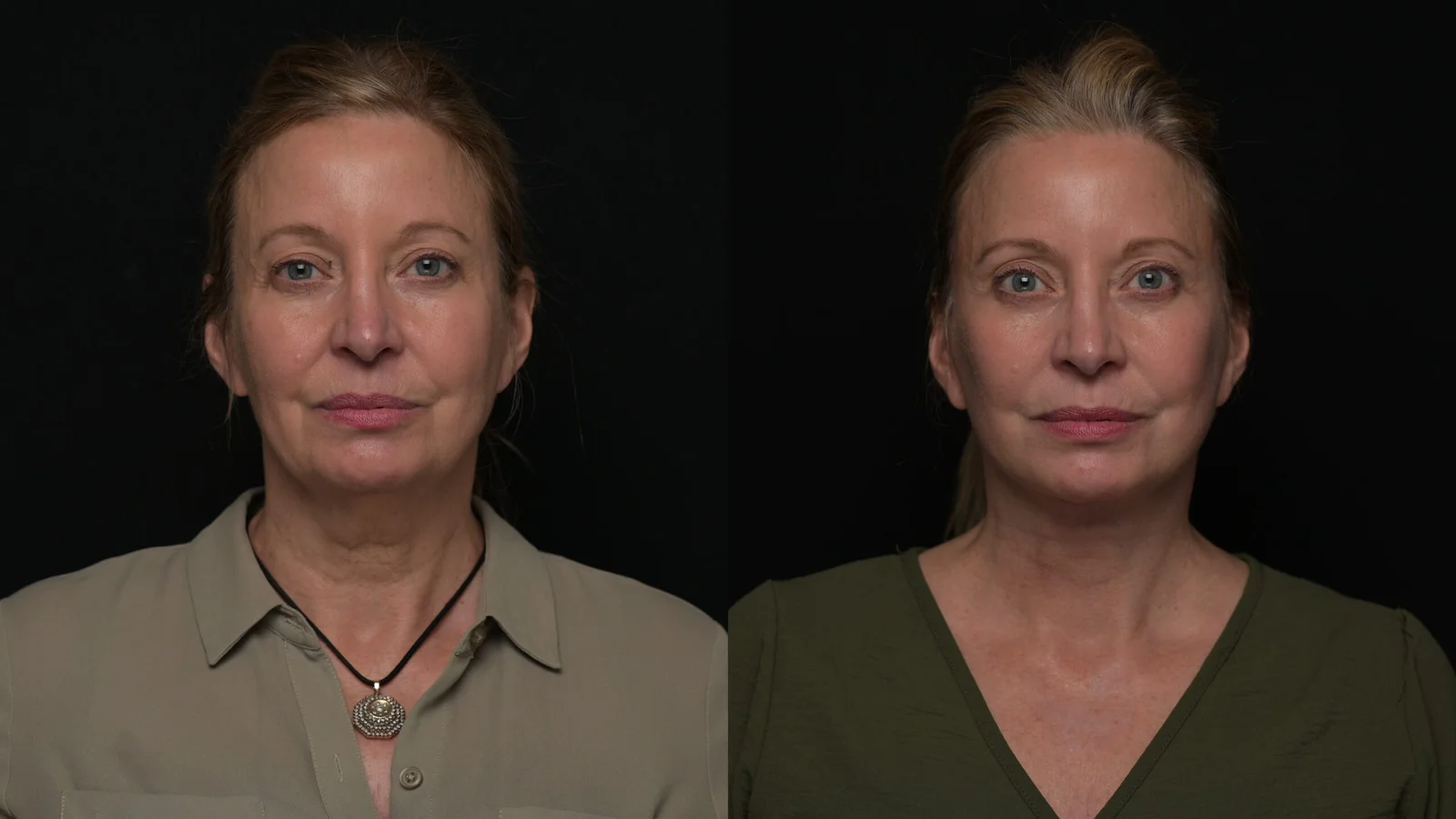 Before-and-after photograph, deep plane facelift and neck lift