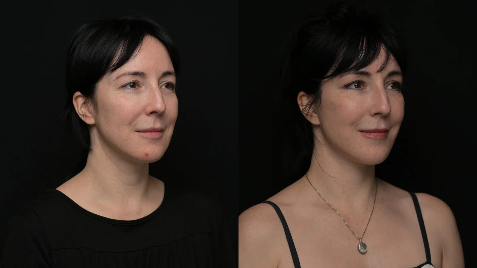 Before-and-after photograph, deep plane facelift and neck lift