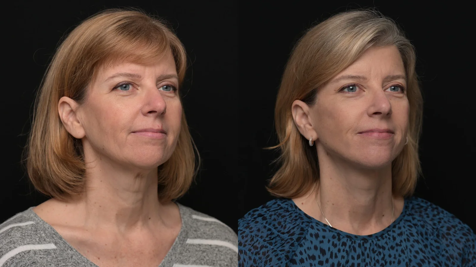 Before-and-after photograph, deep plane facelift and neck lift