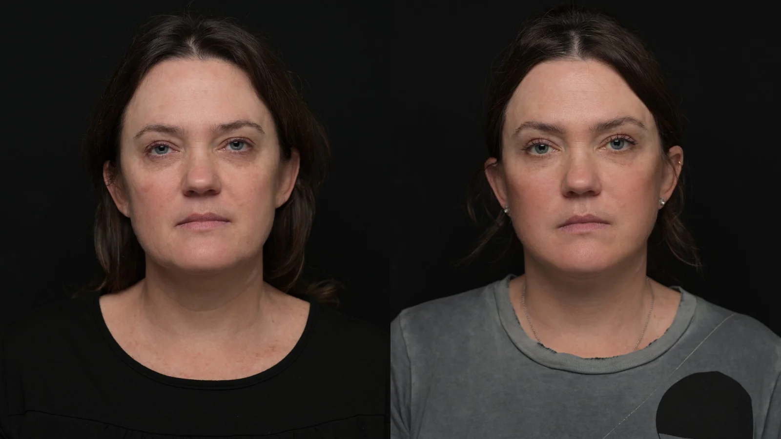 Before-and-after photograph, deep plane facelift and neck lift