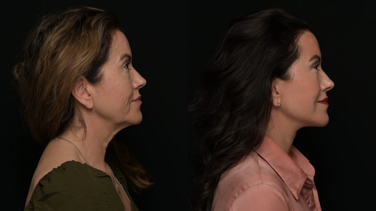 Before-and-after photograph, deep plane facelift and neck lift