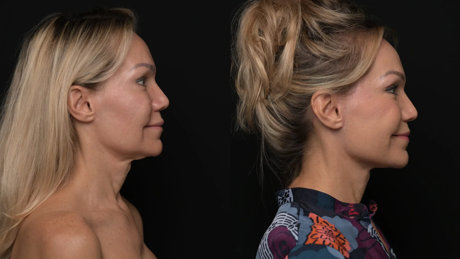 Before-and-after photograph, deep plane facelift and neck lift