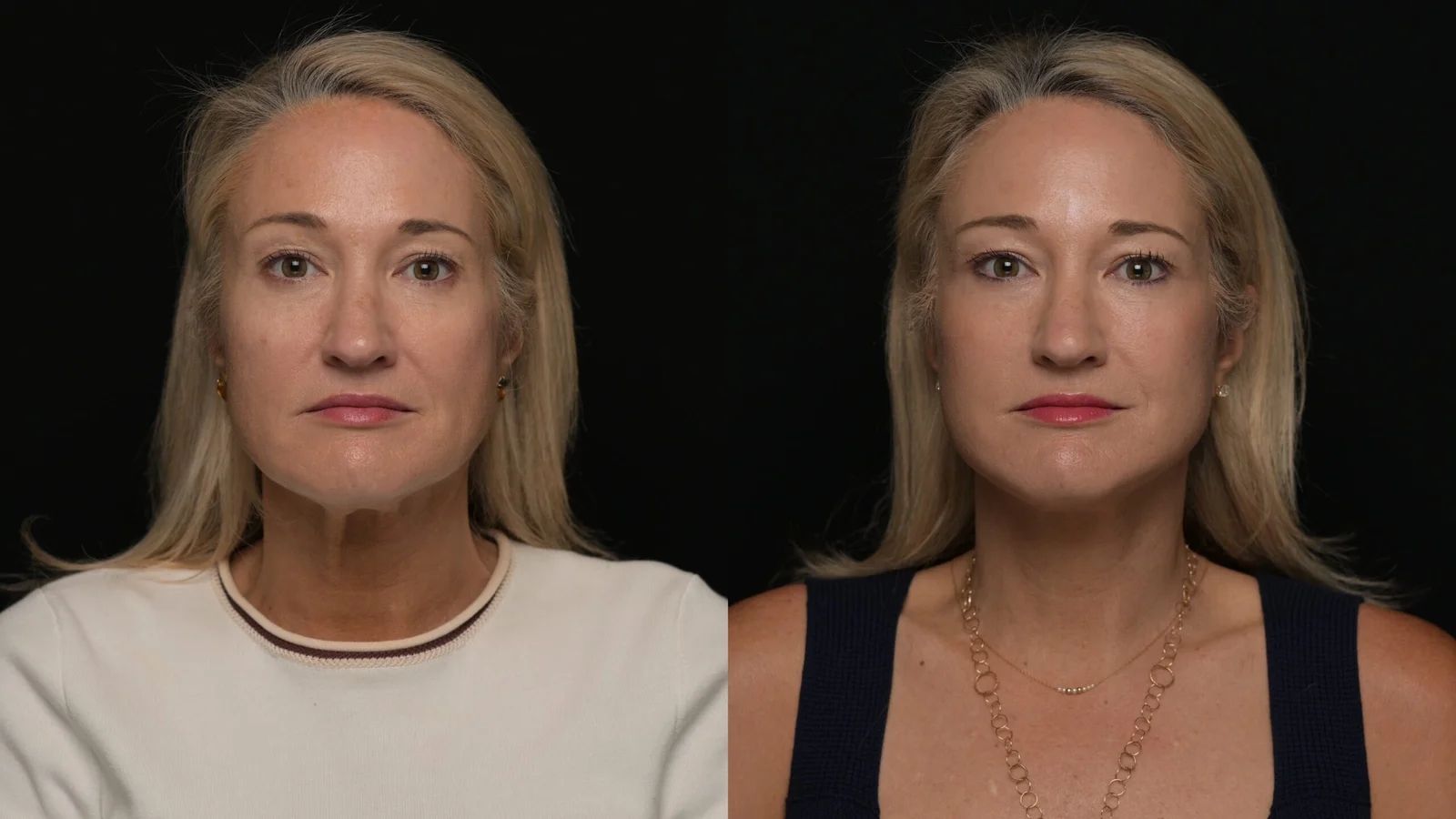 Before-and-after photograph, deep plane facelift and neck lift