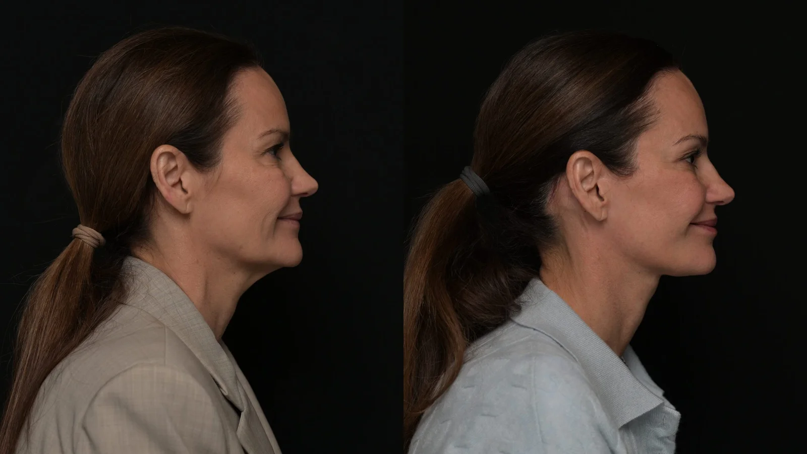 Before-and-after photograph, deep plane facelift and neck lift