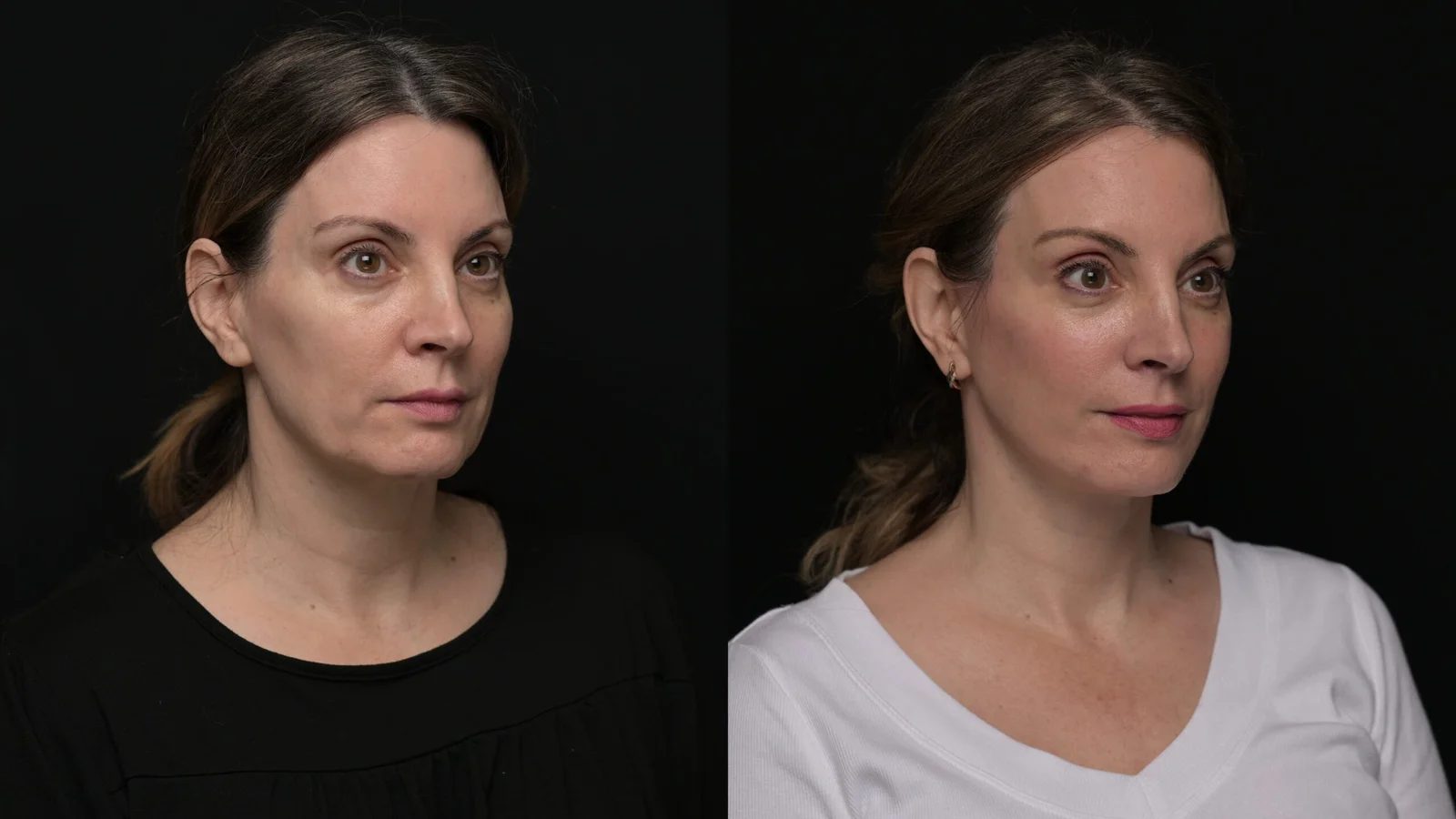 Before-and-after photograph, deep plane facelift and neck lift