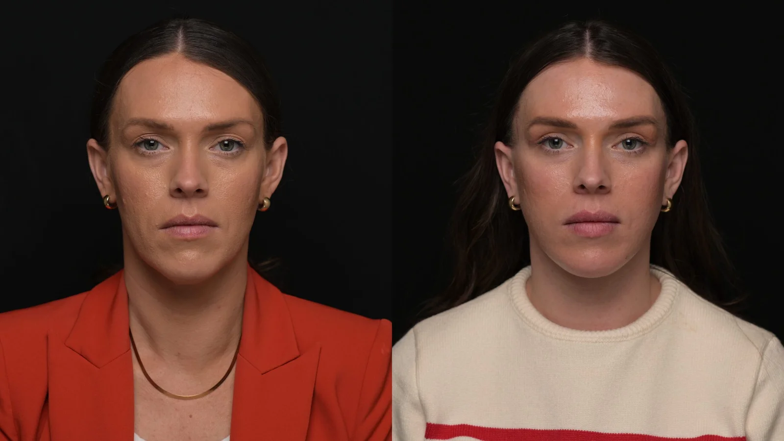Before-and-after photograph, deep plane facelift and neck lift