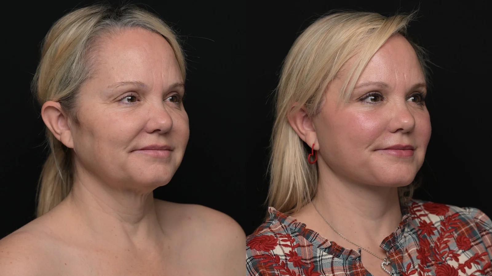 Before-and-after photograph, deep plane facelift and neck lift