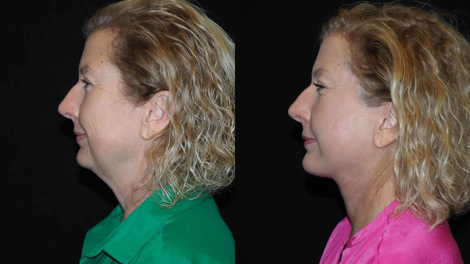 Before-and-after photograph, deep plane facelift and neck lift
