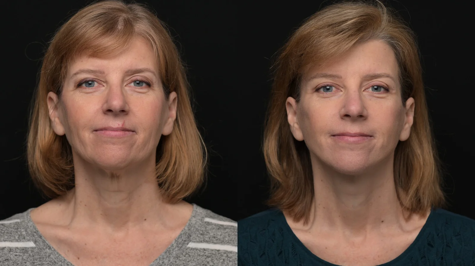 Before-and-after photograph, deep plane facelift, neck lift and blepharoplasty