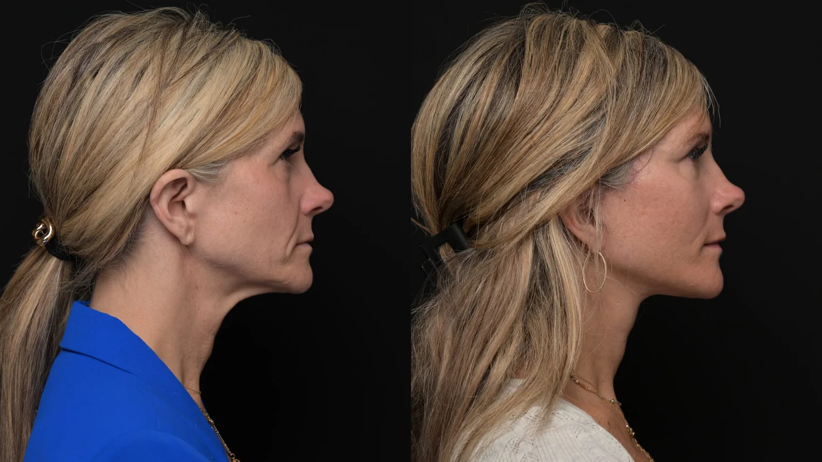 Before-and-after photograph, deep plane facelift and neck lift