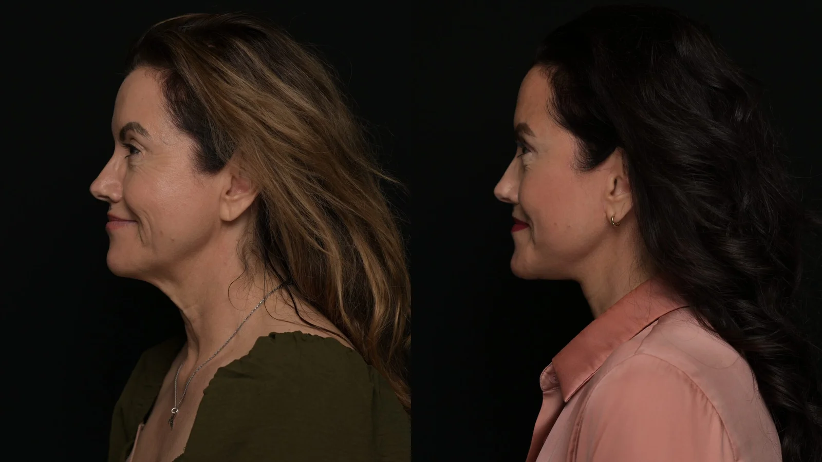 Before-and-after photograph, deep plane facelift and neck lift