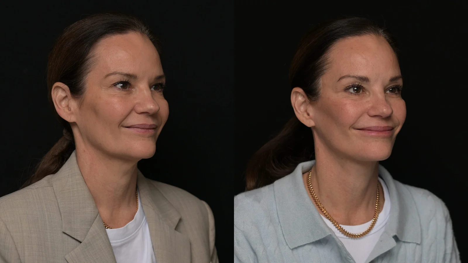 Before-and-after photograph, deep plane facelift and neck lift