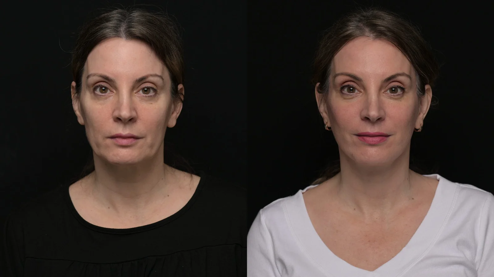 Before-and-after photograph, deep plane facelift and neck lift