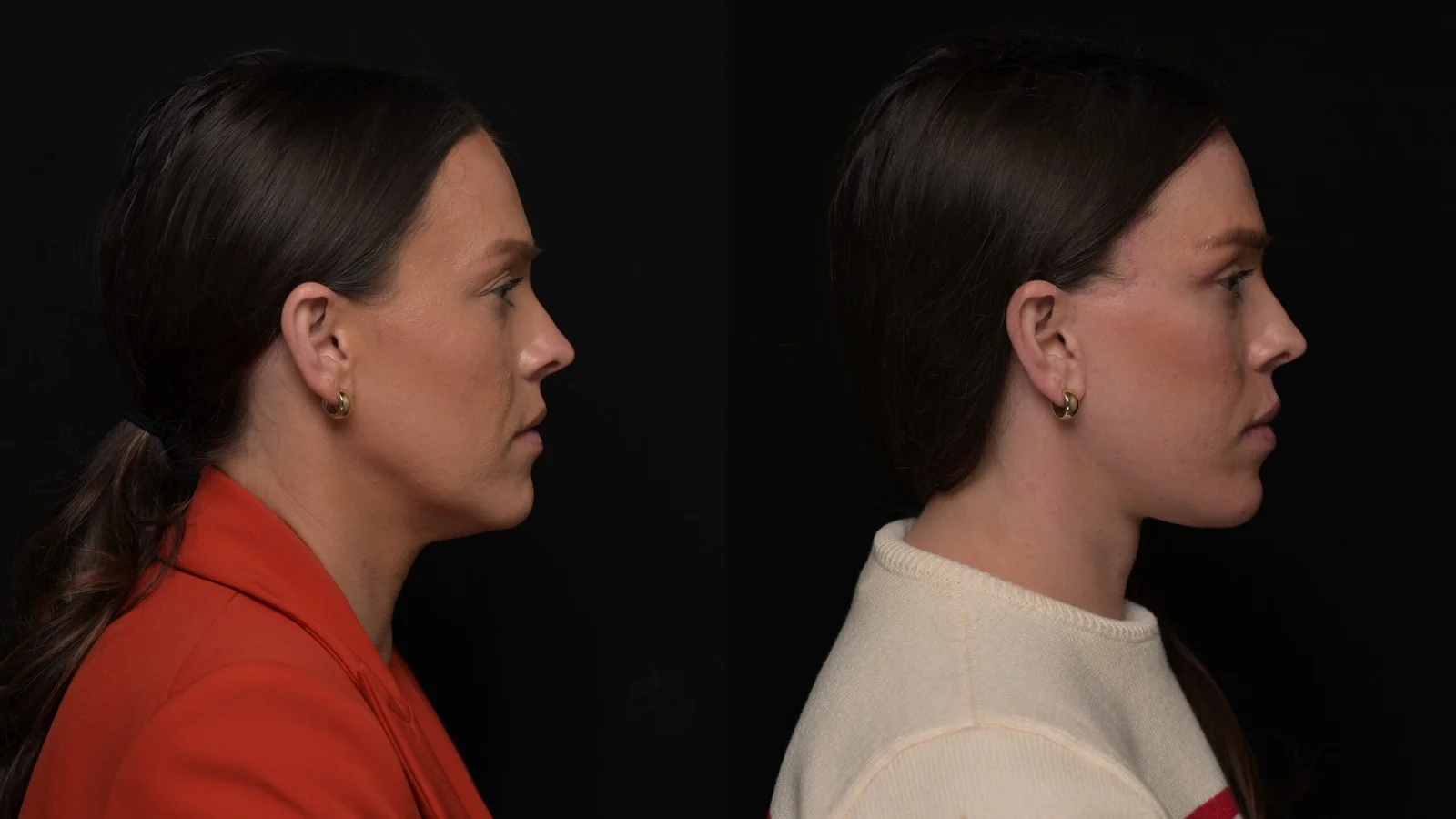 Before-and-after photograph, deep plane facelift and neck lift