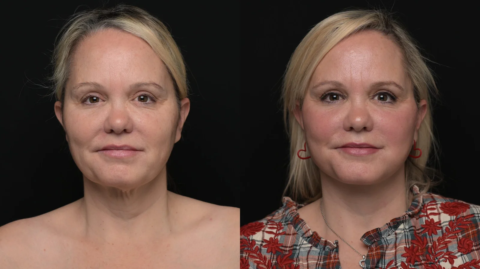Before-and-after photograph, deep plane facelift and neck lift