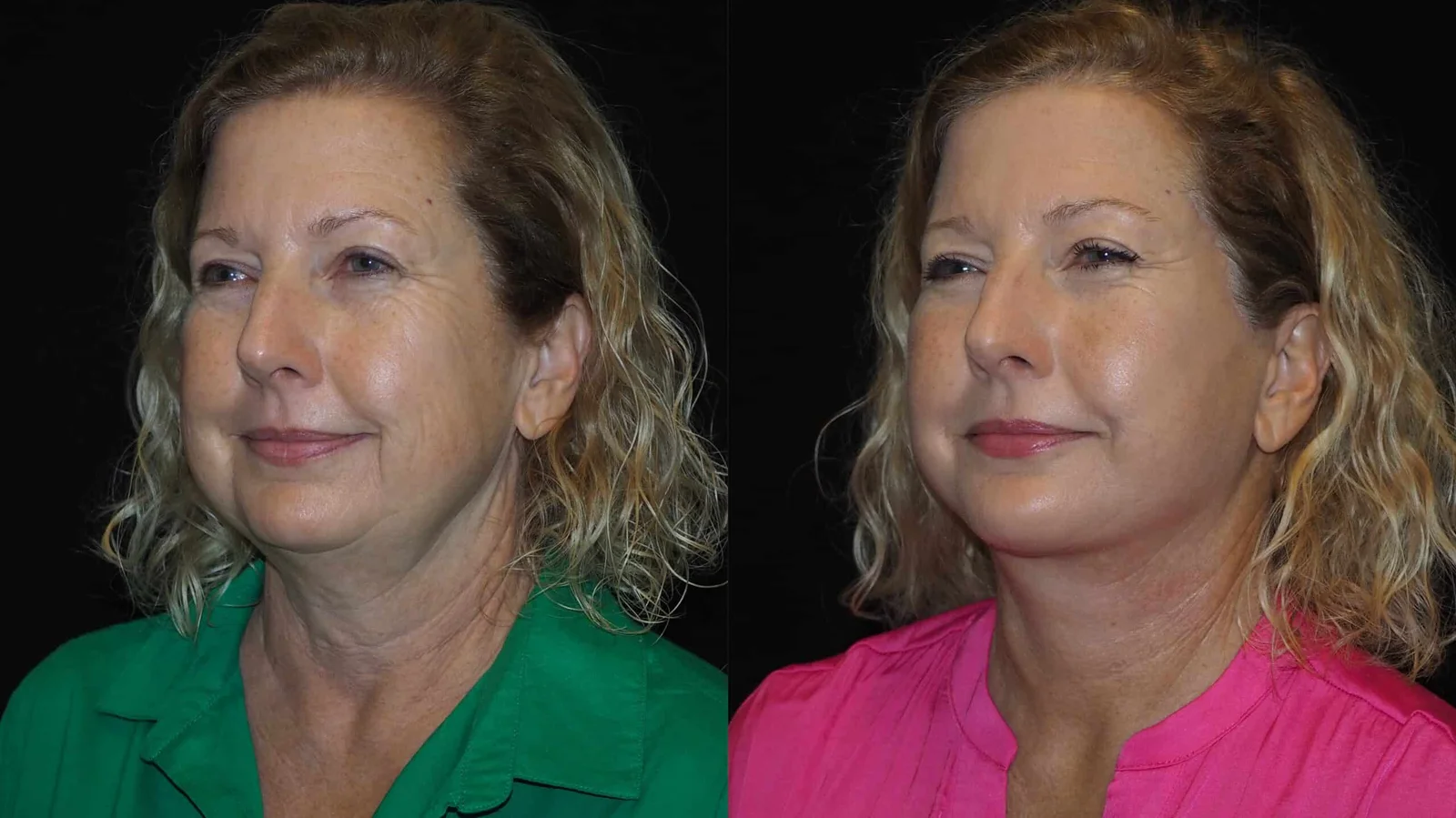 Before-and-after photograph, deep plane facelift and neck lift