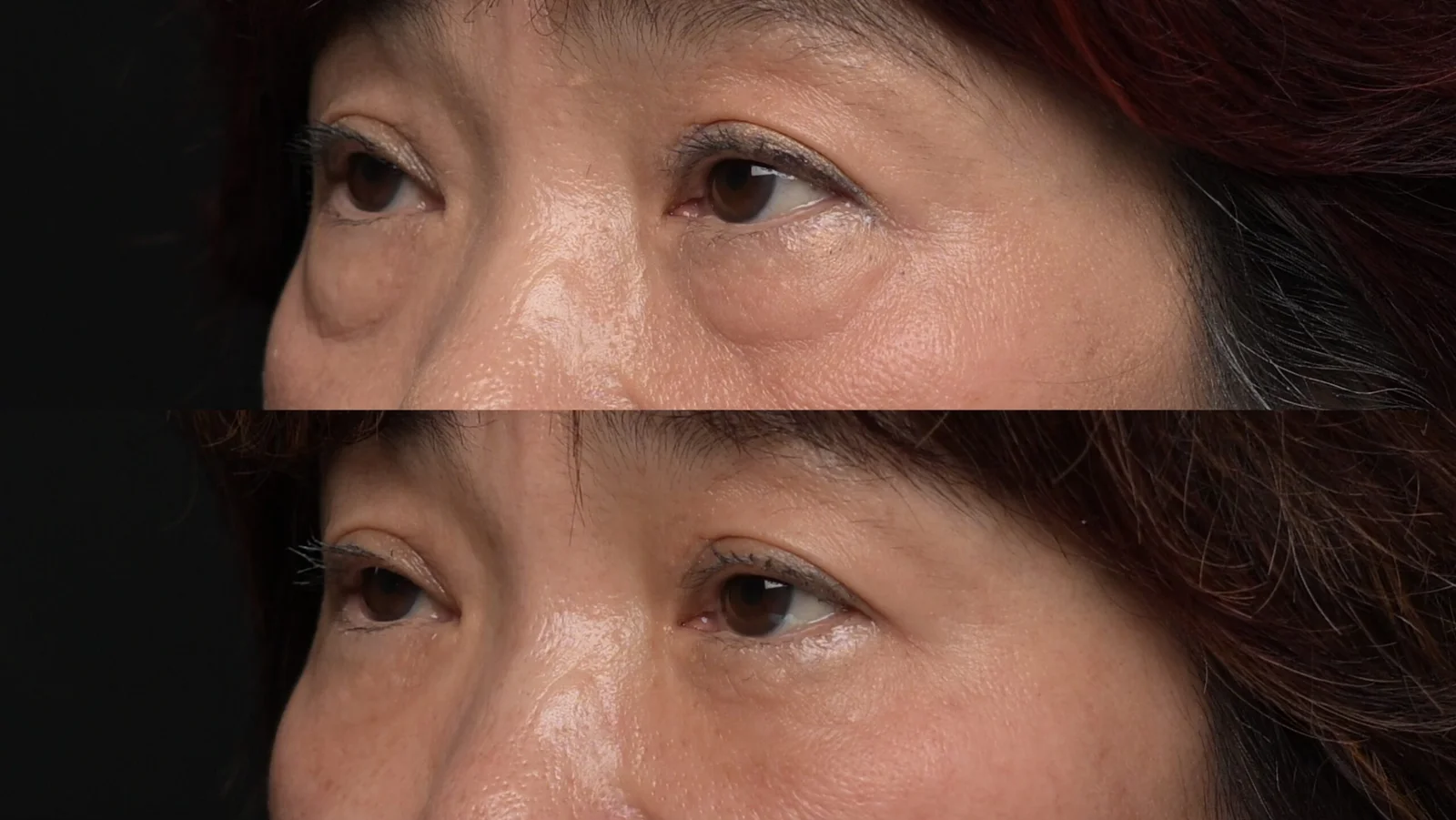 Before-and-after photograph, blepharoplasty