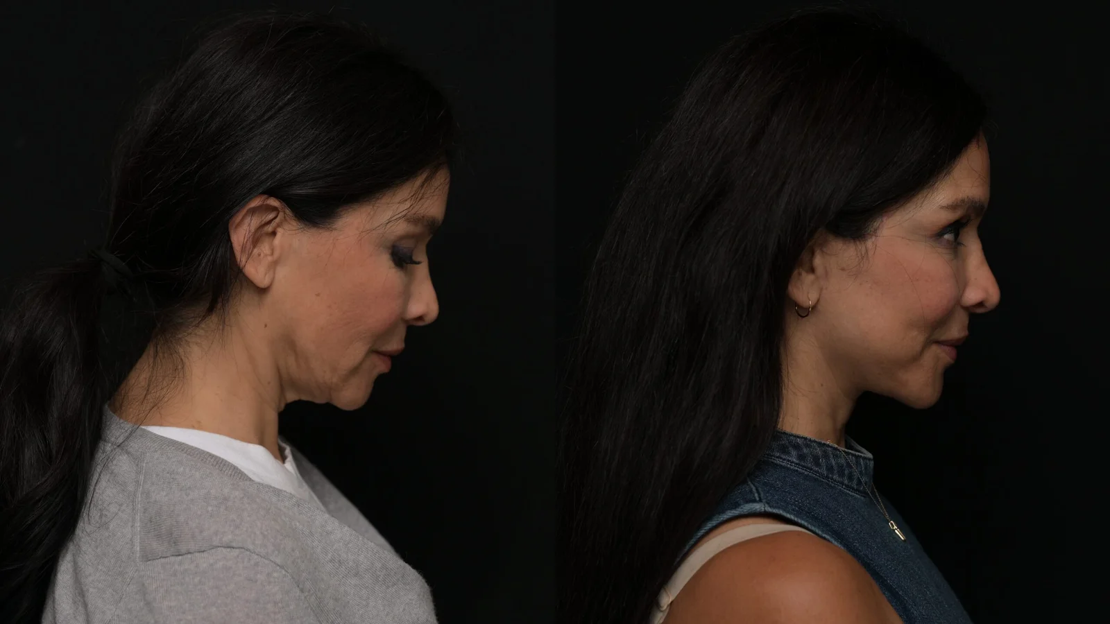Before-and-after photograph, deep plane facelift and neck lift