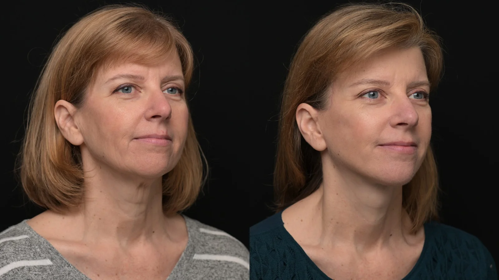 Before-and-after photograph, deep plane facelift, neck lift and blepharoplasty