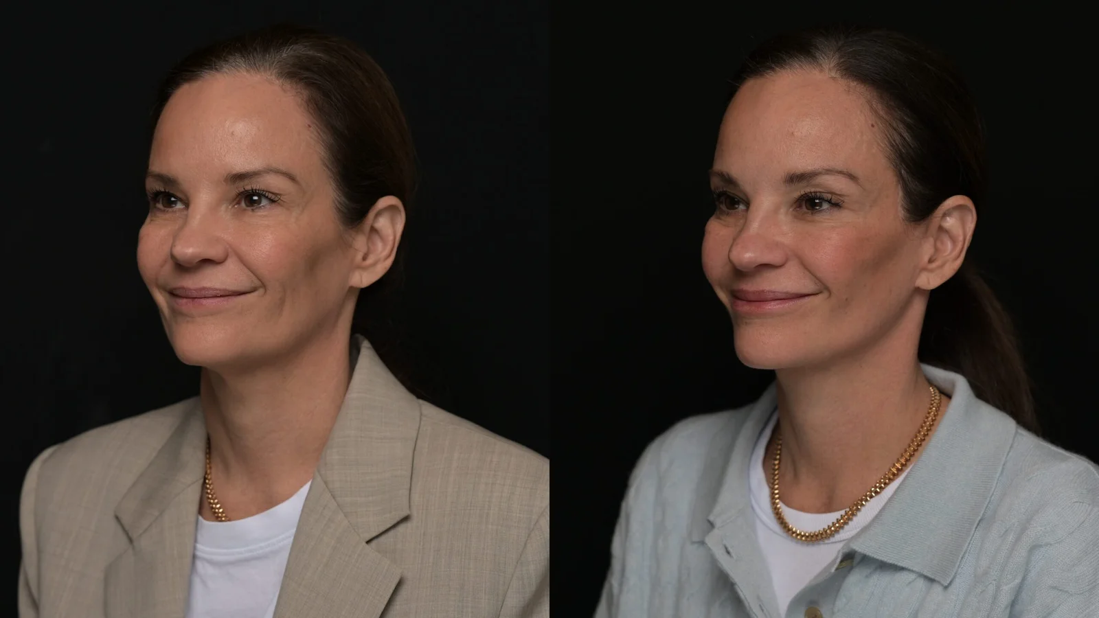 Before-and-after photograph, deep plane facelift and neck lift