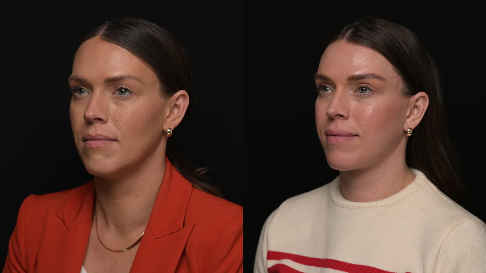 Before-and-after photograph, deep plane facelift and neck lift