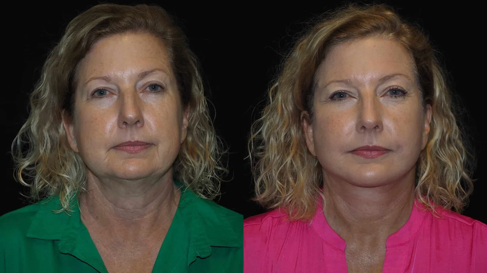 Before-and-after photograph, deep plane facelift and neck lift