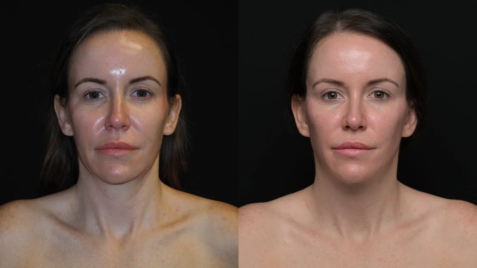 Before-and-after photograph, deep plane facelift and neck lift